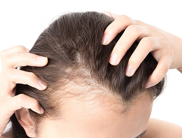 PRP for Hair Loss Treatment