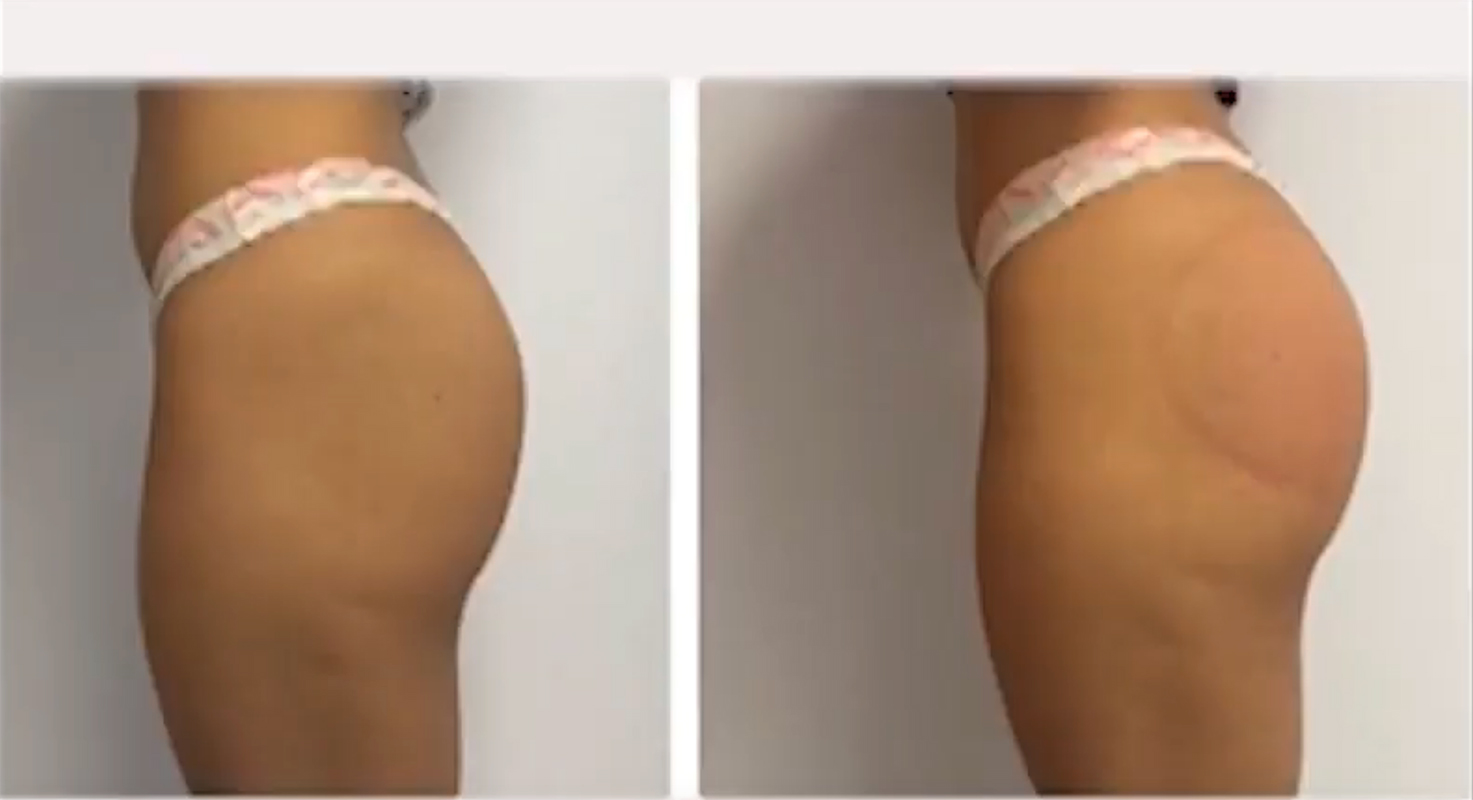Emsculpt®: Learn About This Noninvasive Butt Lift: New Tampa